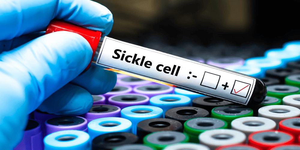 Sickle Cell Disease Health Insurance Coverage: What’s Included?